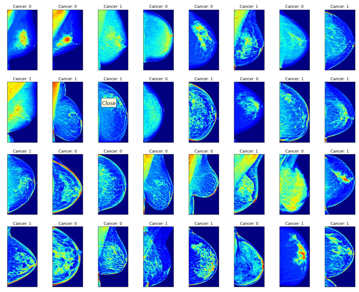 Breast Cancer Detection